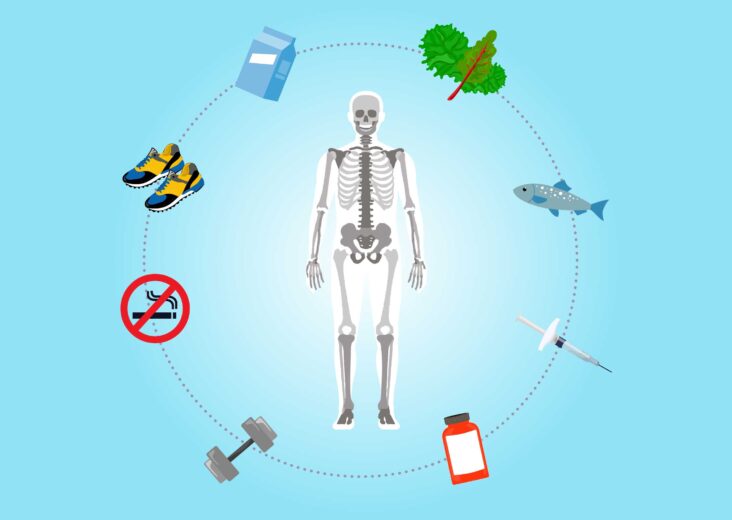 Strategies for Preventing Bone Fractures