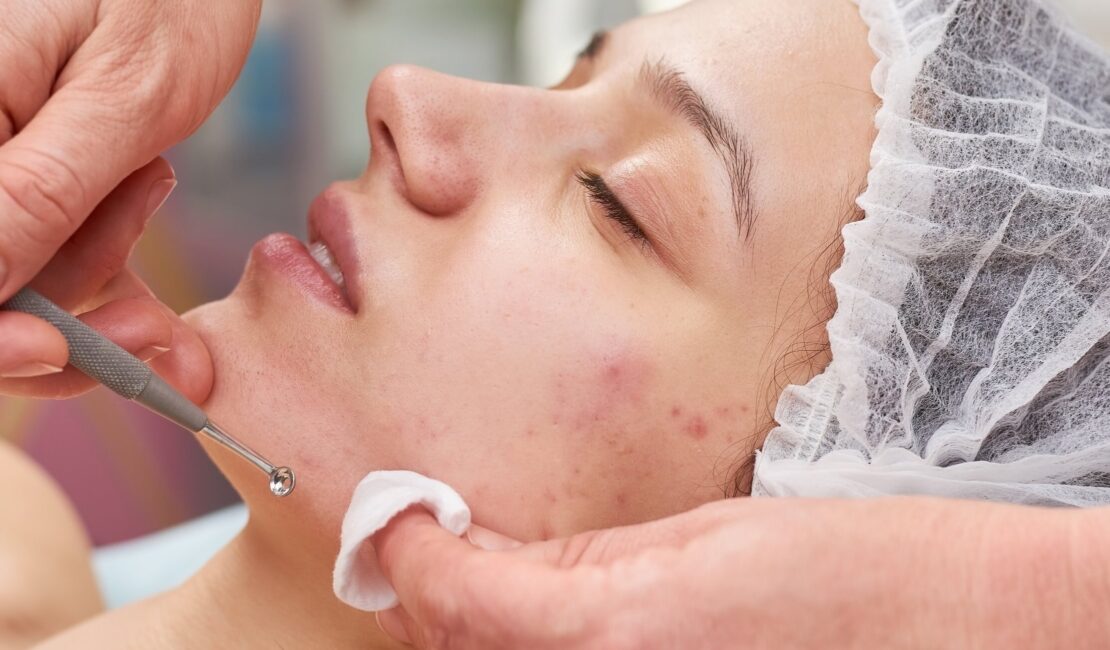 A Comprehensive Guide to Effective Acne Treatment