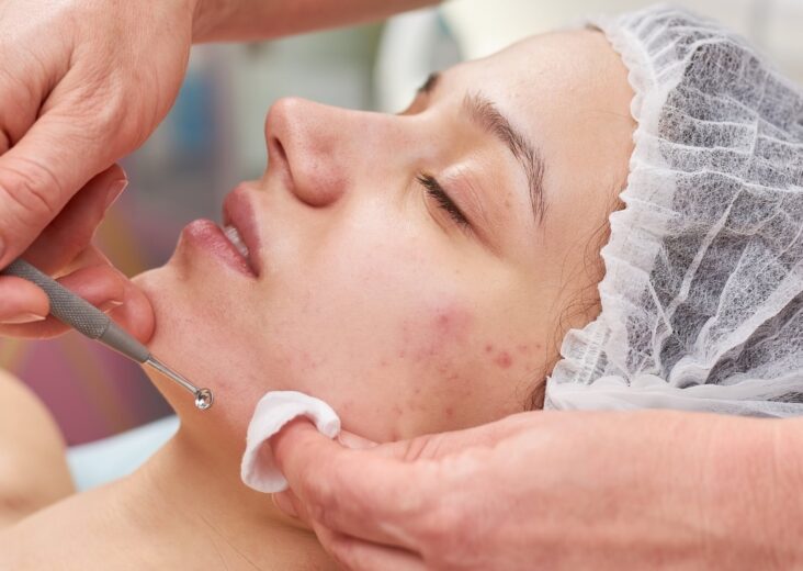 A Comprehensive Guide to Effective Acne Treatment