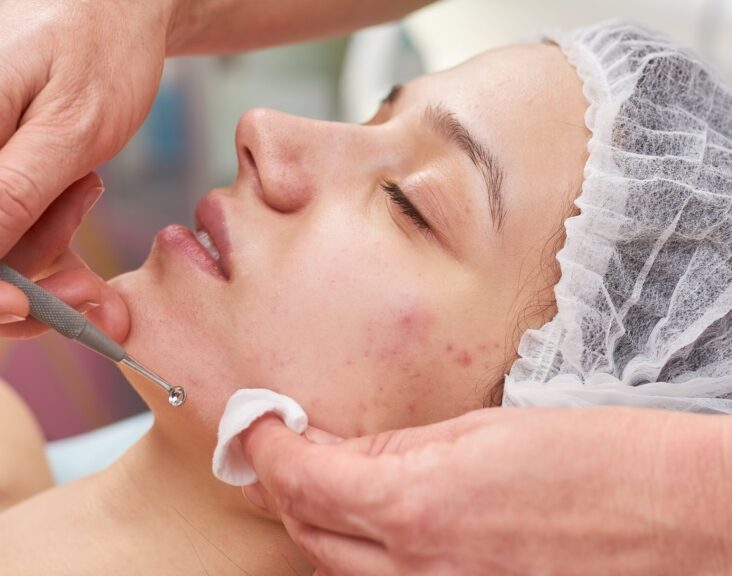 A Comprehensive Guide to Effective Acne Treatment