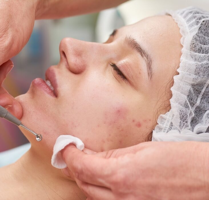 A Comprehensive Guide to Effective Acne Treatment