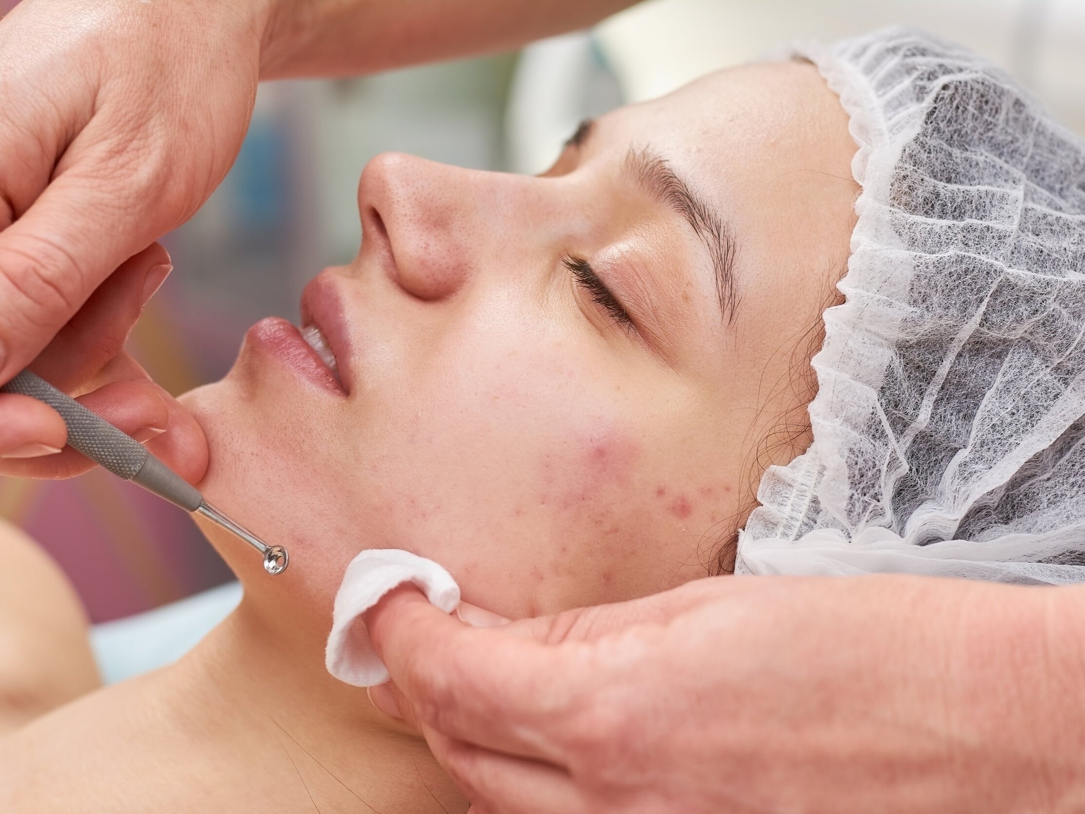 A Comprehensive Guide to Effective Acne Treatment