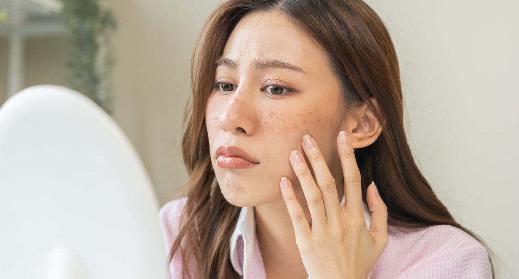 A Comprehensive Guide to Effective Acne Treatment