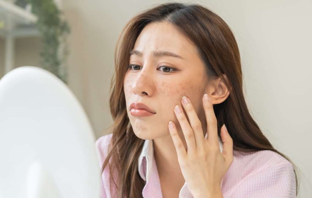 A Comprehensive Guide to Effective Acne Treatment