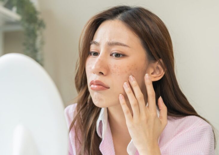 A Comprehensive Guide to Effective Acne Treatment