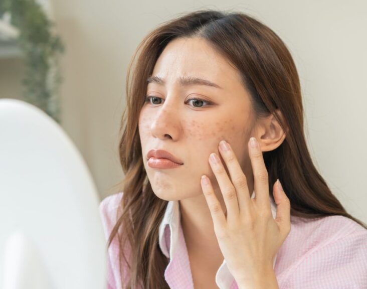 A Comprehensive Guide to Effective Acne Treatment