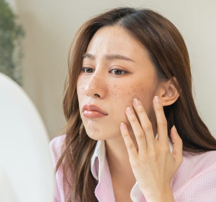 A Comprehensive Guide to Effective Acne Treatment