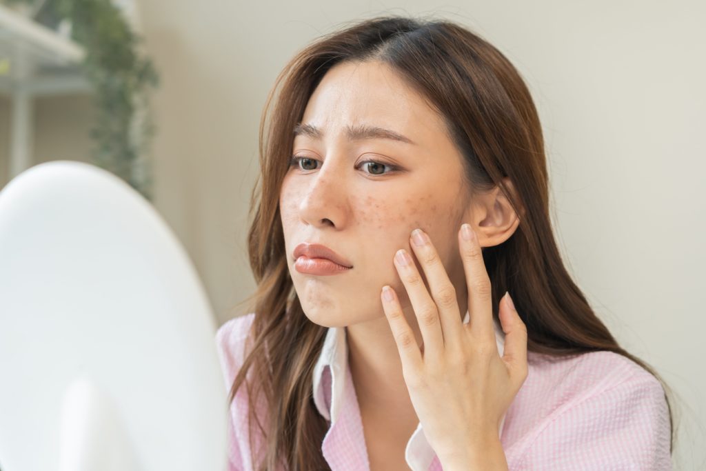 A Comprehensive Guide to Effective Acne Treatment