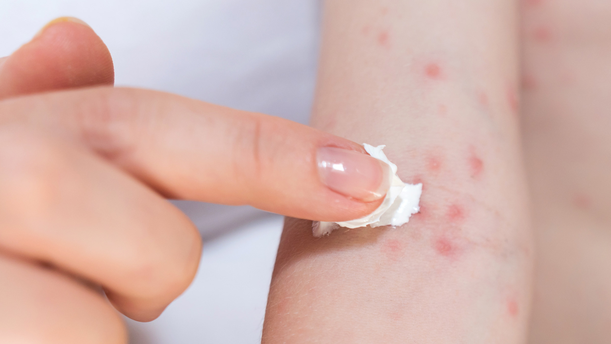 Natural Remedies for Skin Rashes: Soothe Irritation the Gentle Way